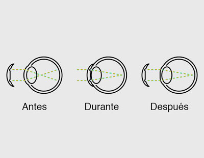 Cómo funcionan las lentillas nocturnas